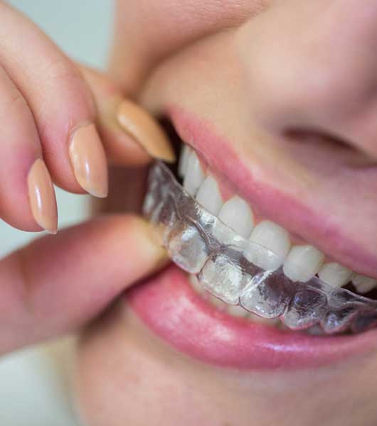 Alineador dental de GM Ortodoncia Invisible – Mendoza Matos Odontología Especializada