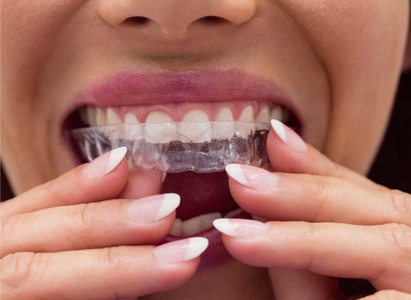 Alineadores-Dentales-Mendoza-Matos